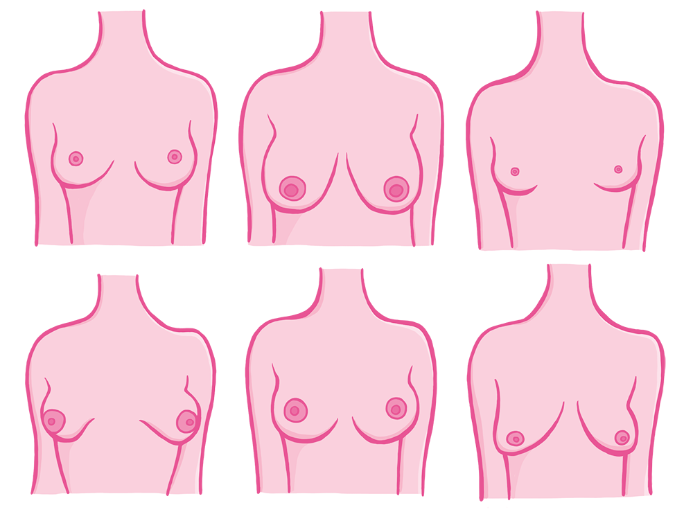Are Underdeveloped Breast Common in Teenage Girls?