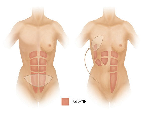 How a “New” Belly Button is Created During DIEP Flap Breast