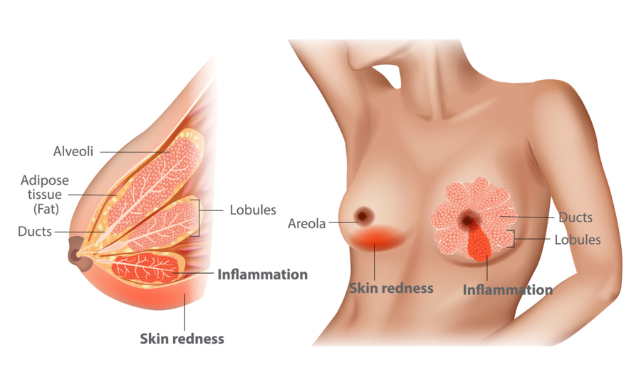 Sore under breast (pic)