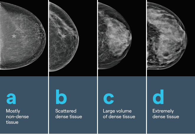 What Having Dense Breasts Means For Your Health