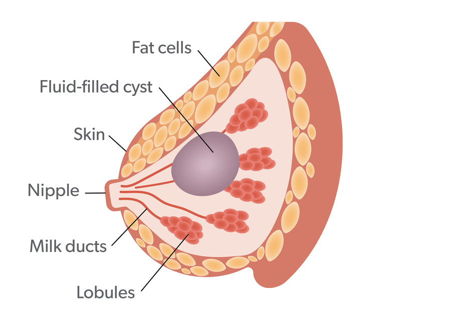 breast-cyst-diagram-breast-conditions.png